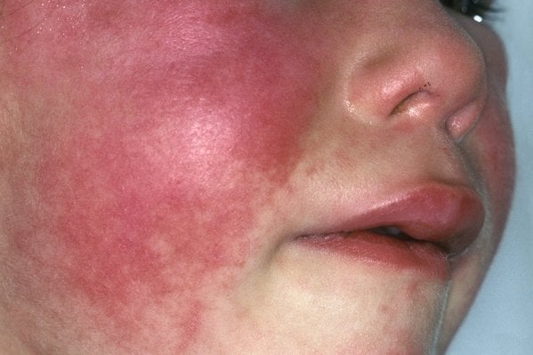 Health warning amid rise in scarlet fever cases on island