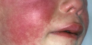 Warning after rise in scarlet fever cases
