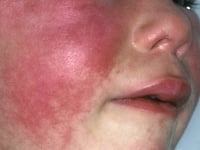 Warning after rise in scarlet fever cases