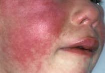 Public Health issues warning amid rise in scarlet fever cases on island