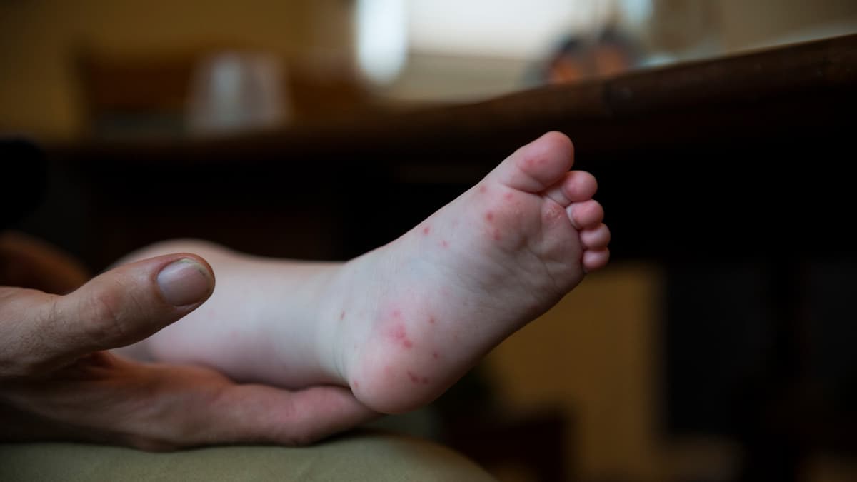Hand, foot and mouth disease 'circulating in the Isle of Man' at
