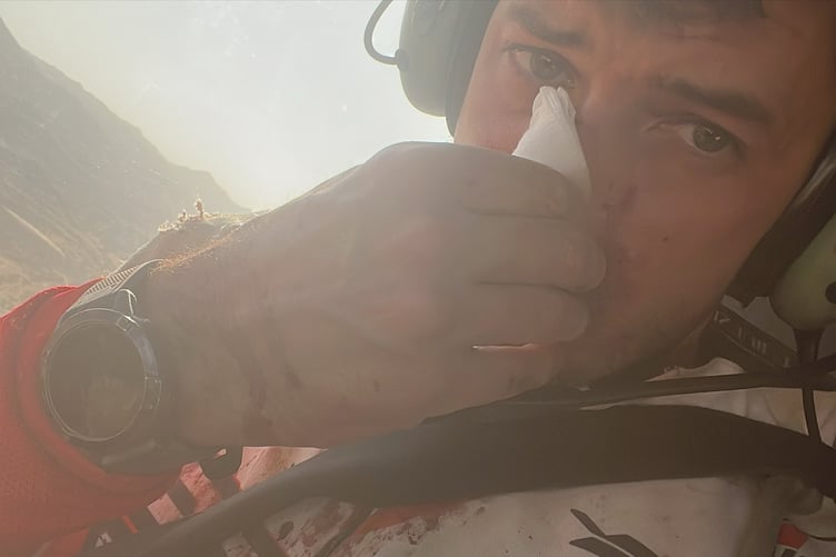 James Hillier after breaking his nose on Saturday