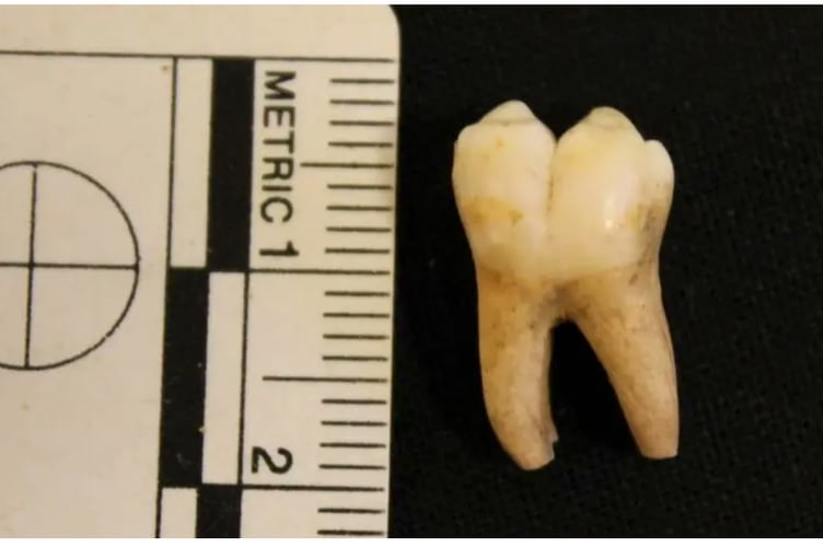 A medieval tooth prepared for analysis