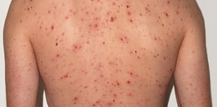 Free chickenpox vaccination to be offered to children from January