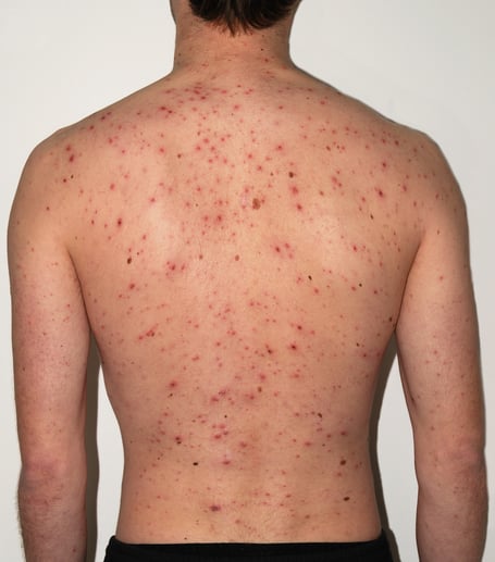Chickenpox