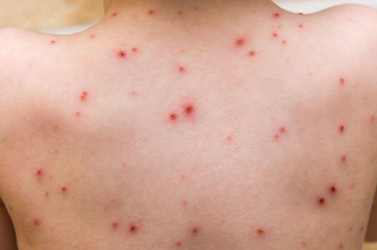 Manx Care say the vaccines offer protection against chickenpox alongside measles, mumps and rubella
