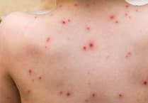 Children in the island to receive chickenpox vaccine