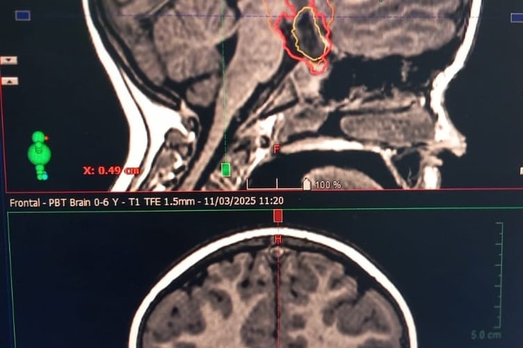 An MRI scan showing Hector's tumour